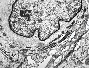 F, 49y. | myelosarcoma … histiocyte-like cells in dermal infiltrates F, 49y. | myelosarcoma … histiocyte-like cells in dermal infiltrates
